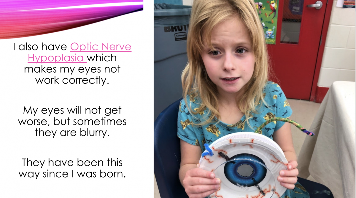I also have Optic Nerve Hypoplasia which makes my eyes not work correctly, My eye will not get worse, but sometimes they are blurry. They have been this way since I was born. I also have Optic Nerve Hypoplasia which makes my eyes not work correctly, My eye will not get worse, but sometimes they are blurry. They have been this way since I was born.